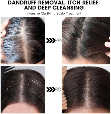 Dead Sea Salt Scalp Scrub 280g - Exfoliator for Oily Scalp, Itchy Scalp &amp; Dandruff Relief - Clarifying Hair Treatment with Herbal Essences for Scalp Build-Up, Flakes &amp; Hair Growth